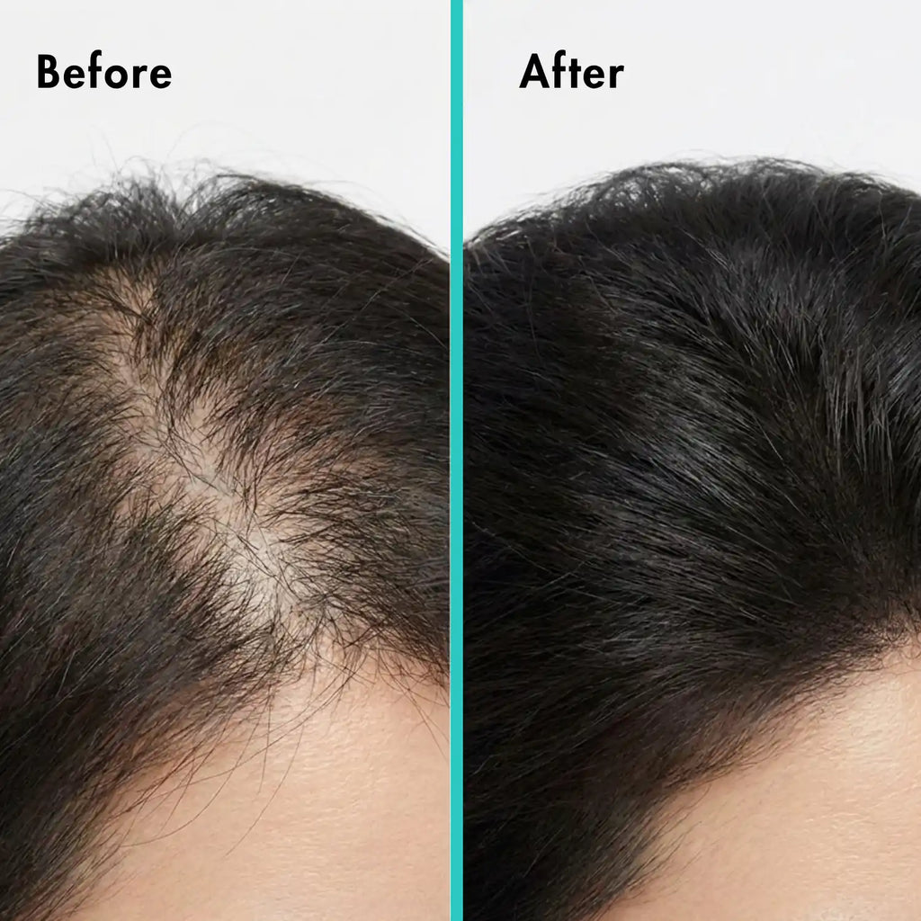 Korean Root Reboot PDRN Microneedling